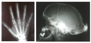 <span class="mw-page-title-main">Hajdu–Cheney syndrome</span> Medical condition