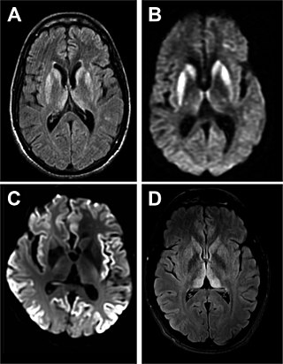 <span class="mw-page-title-main">Creutzfeldt–Jakob disease</span> Degenerative neurological disorder