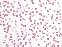 Rouleaux formation in a peripheral blood smear from a patient with plasma cell myeloma. Rouleaux.jpg