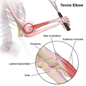 Tennis Elbow Tennis Elbow.png