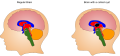 This is an image of a regular brain and a brain with a colloid cyst.