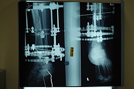 X-ray perspectives of the progress of the healing of the open fracture, four months post-fracture.