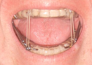 <span class="mw-page-title-main">Mandibular advancement splint</span>