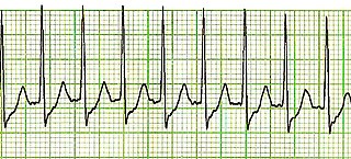 Supraventricular tachycardia Abnormally fast heart rhythm arising from upper part of the heart