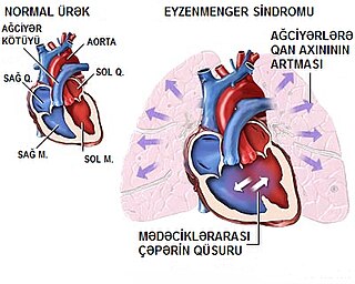 Eisenmengers syndrome Medical condition