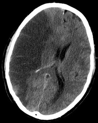 <span class="mw-page-title-main">Brain ischemia</span> Medical condition