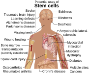 Áreas do corpo humano onde a aplicação da terapia com células-tronco[4] é promissora.