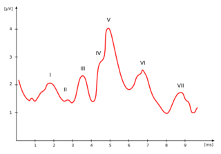 <span class="mw-page-title-main">Auditory brainstem response</span> Auditory phenomenon in the brain