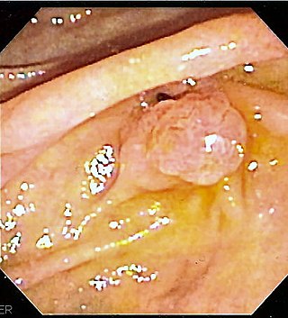 <span class="mw-page-title-main">Hemosuccus pancreaticus</span> Medical condition