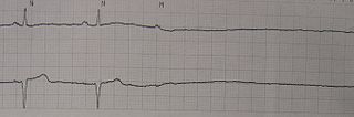 <span class="mw-page-title-main">Asystole</span> Medical condition of the heart