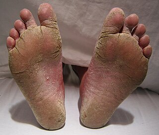 <span class="mw-page-title-main">Athlete's foot</span> Skin infection caused by fungus