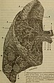 Diagrammatic view of lung showing magnified inner structures including alveolar sacs at 10) and lobules at 9)