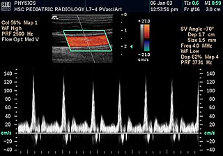 <span class="mw-page-title-main">Doppler ultrasonography</span> Ultrasound imaging of the movement of tissues and body fluids using the Doppler effect