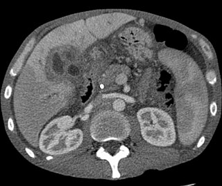 <span class="mw-page-title-main">Liver cancer</span> Medical condition