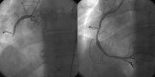 <span class="mw-page-title-main">Interventional cardiology</span>