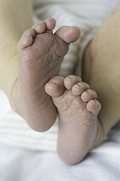 The feet of a newborn infant Newborn-Baby-Feet.jpg