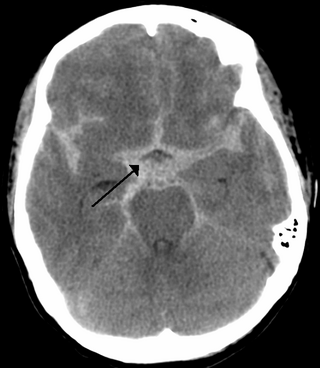 <span class="mw-page-title-main">Subarachnoid hemorrhage</span> Bleeding into the subarachnoid space