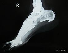 Inferior calcaneal spur Calcaneal spur.jpg