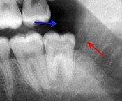 xray of pericoronitis