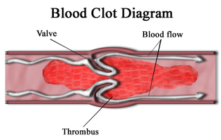 <span class="mw-page-title-main">Thrombus</span> Blood clot