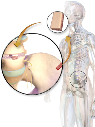 <span class="mw-page-title-main">Phemister graft</span>