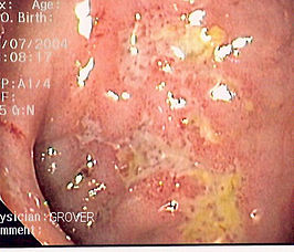 Endoscopische foto van de dikke darm met een chronische zweer