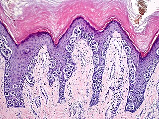 <span class="mw-page-title-main">Acral nevus</span> Medical condition