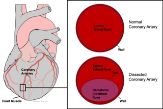 <span class="mw-page-title-main">Spontaneous coronary artery dissection</span> Uncommon cause of heart attacks mostly affecting younger, healthy women