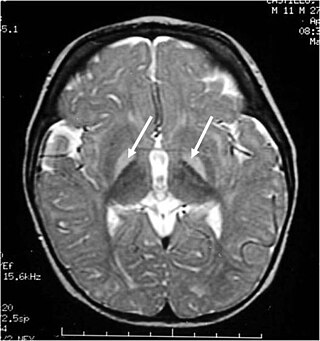 <span class="mw-page-title-main">Kernicterus</span> Medical condition