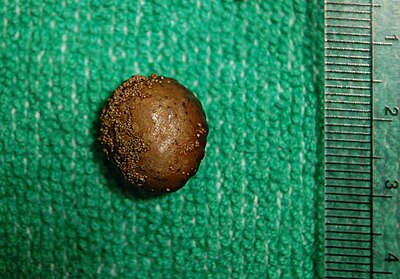 A bladder stone.