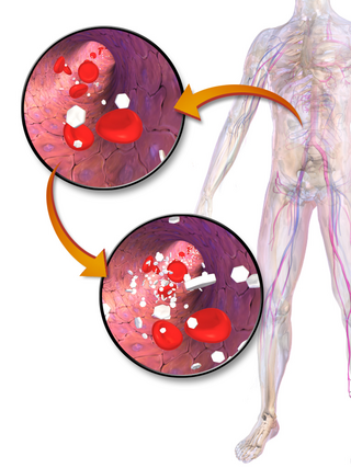 <span class="mw-page-title-main">Hyperglycemia</span> Too much blood sugar, usually because of diabetes