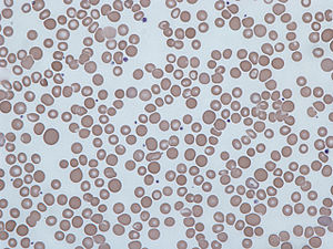 Anisocytosis.jpg