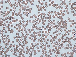 <span class="mw-page-title-main">Anisocytosis</span> Medical condition