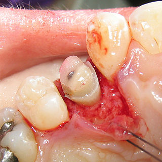 Crown lengthening