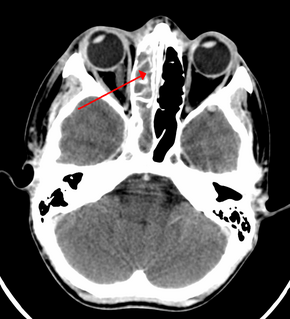 Sinusitis Inflammation of the mucous membrane that lines the sinuses resulting in symptoms