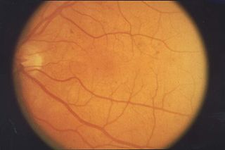 <span class="mw-page-title-main">Retinopathy</span> Damage to the retina of the eyes