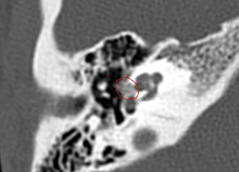 CT scan of otosclerotic focus in the anterior footplate Xray of otosclerosis.jpg