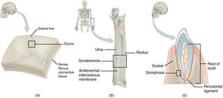 Fibrous joint Fixed joints between bones held together by dense, fibrous tissue