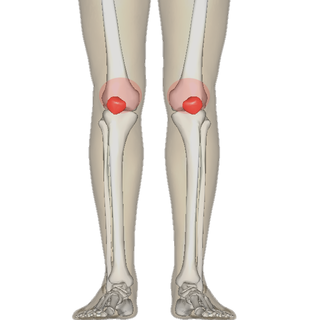 <span class="mw-page-title-main">Patellofemoral pain syndrome</span> Medical condition