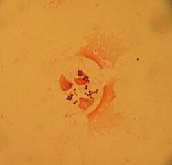 Typical gram-positive cocci, in clusters, from a sputum sample, Gram stain Staph sputum.JPG