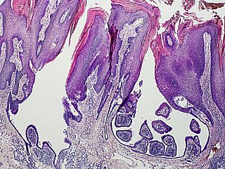 Syringocystadenoma papilliferum Medical condition