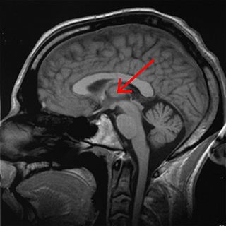 <span class="mw-page-title-main">Thalamus</span> Structure within the brain