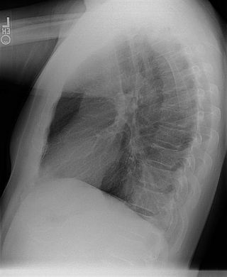 <span class="mw-page-title-main">Pulmonary sequestration</span> Medical condition