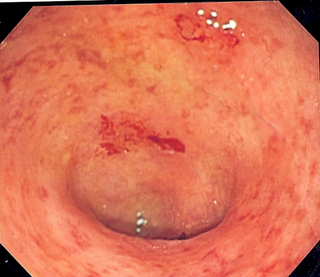 <span class="mw-page-title-main">Ulcerative colitis</span> Inflammatory bowel disease that causes ulcers in the colon