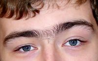 A young adult with hair between the eyebrows—a unibrow