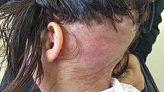 Folliculitis decalvans