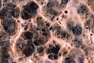 <span class="mw-page-title-main">Emphysema</span> Air-filled enlargement in the bodys tissues