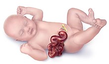 Gastroschisis-web.jpg