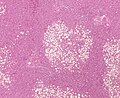 Steatosis with a centrilobular pattern, which is the general tendency for steatosis in adults.[11]