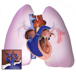 <span class="mw-page-title-main">Pulmonary hypertension</span> Increased blood pressure in lung arteries